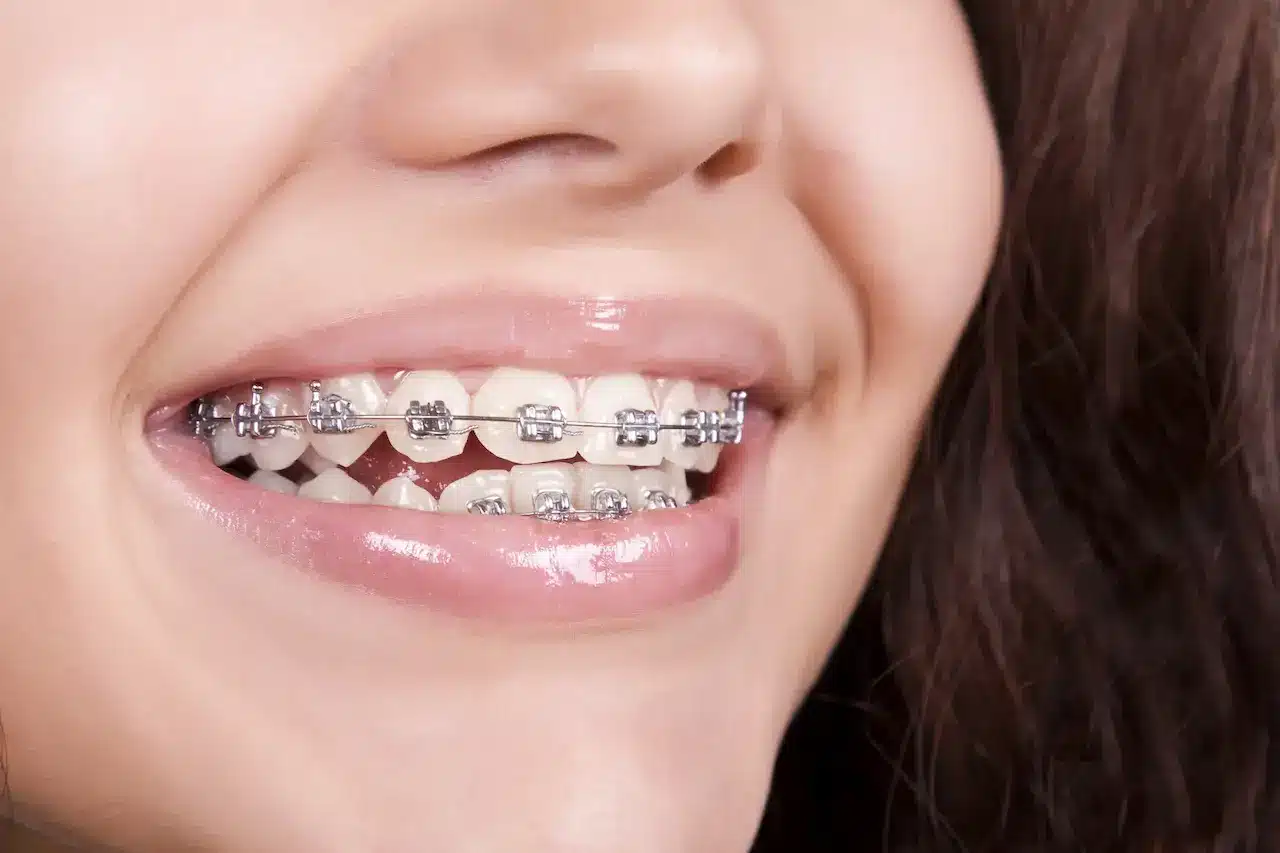 Smiling Woman With Braces 