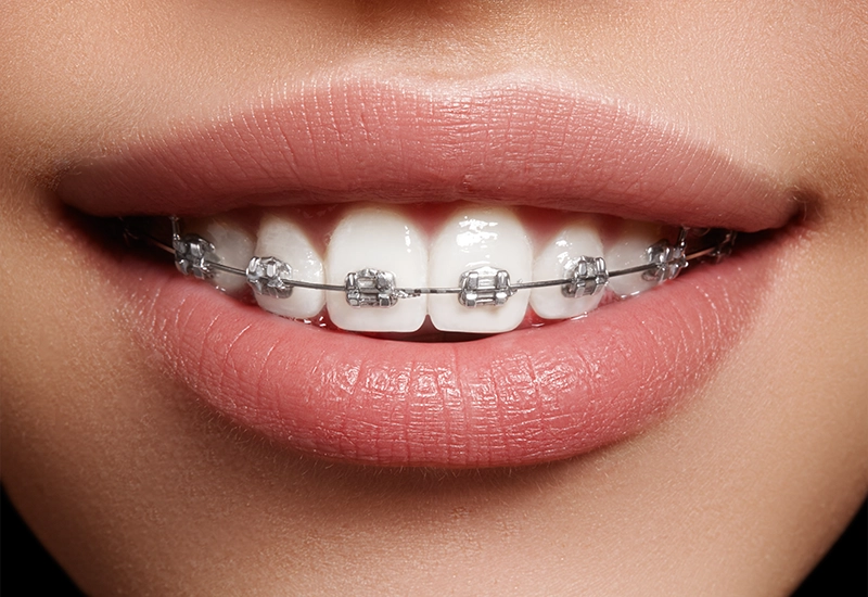 Broken Orthodontic Wire or Bracket