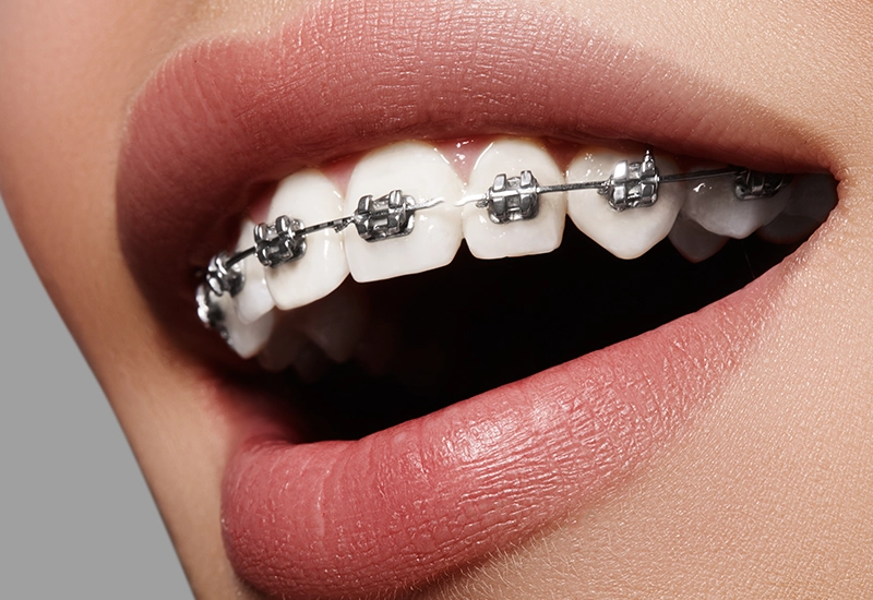 Broken Orthodontic Wire