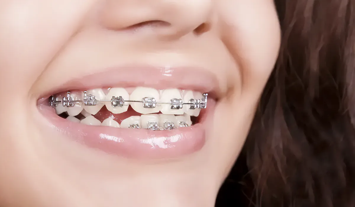 Smiling Woman With Braces Smiling Woman With Braces