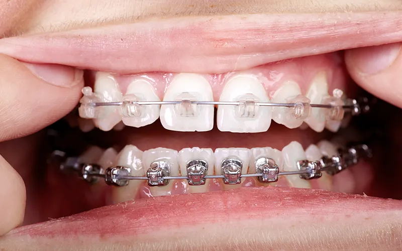 Orthodontic Appliances