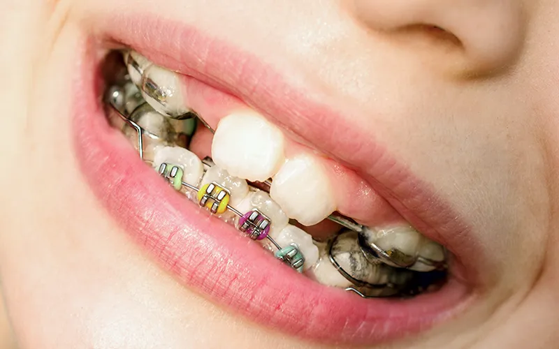 Orthodontic Appliances