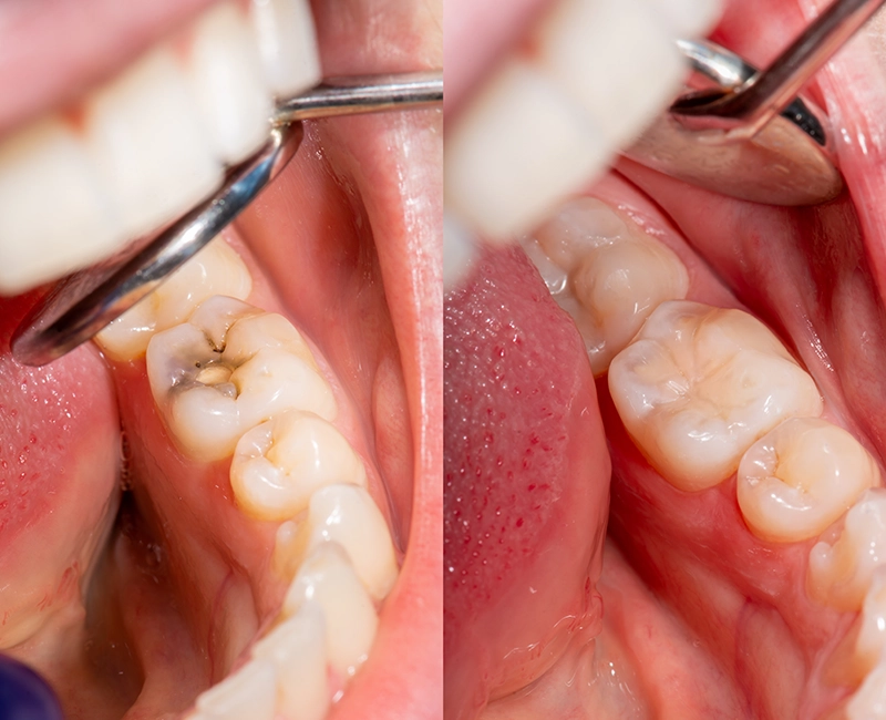 Dental Fillings