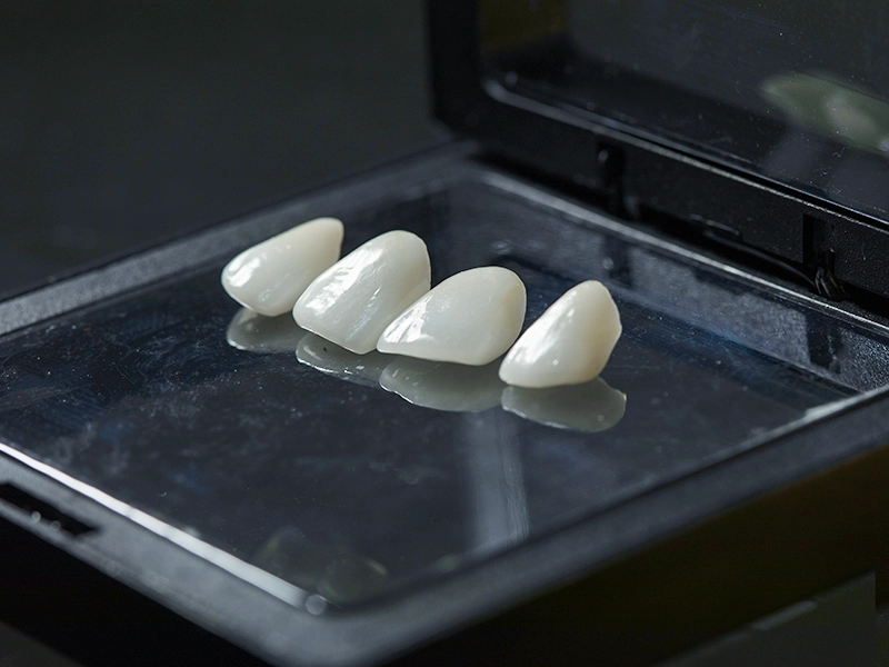 Alma-Dental-Surgery-Dental-Veneers-3D-Print Dental Veneers