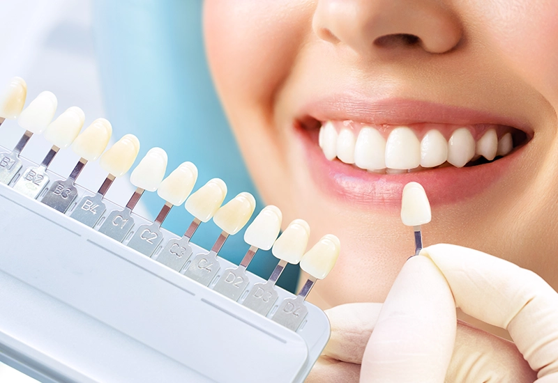 Alma-Dental-Surgery-Dental-Veneers-colour-picking Dental Veneers