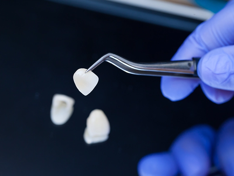 Alma-Dental-Surgery-Dental-Veneers-on-hand Dental Veneers