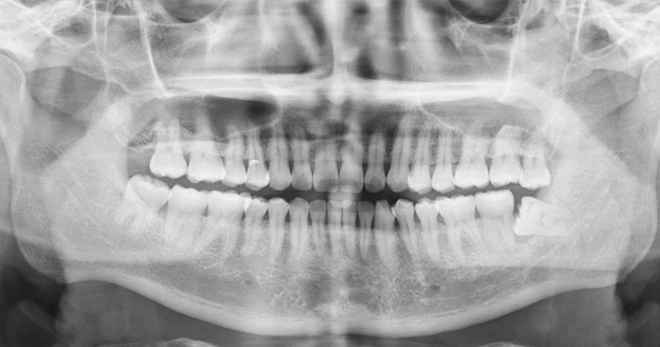 Wisdom Teeth Removal