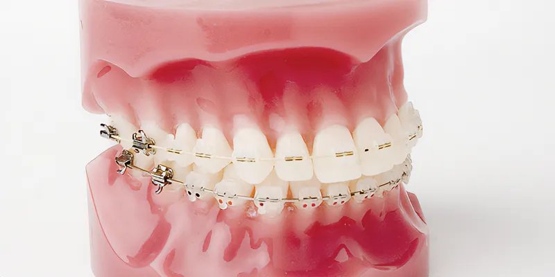 Braces