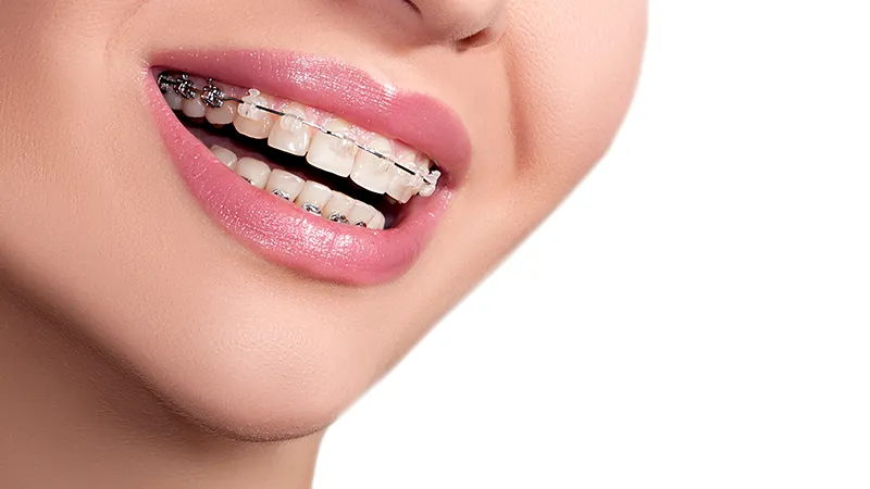 Braces