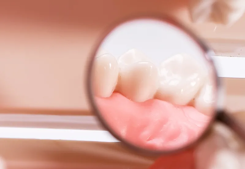 Dental crowns
