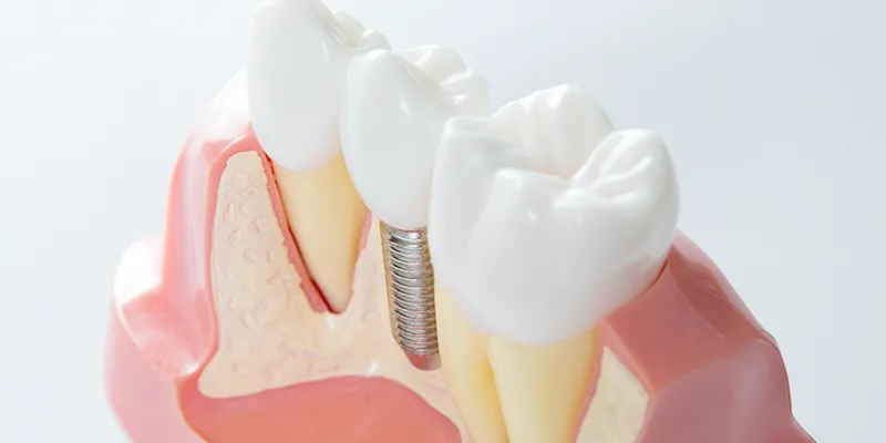Dental implant