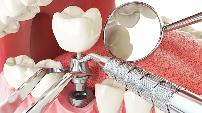 dental implant