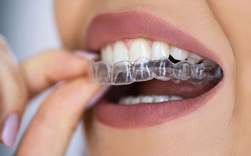 clear aligners
