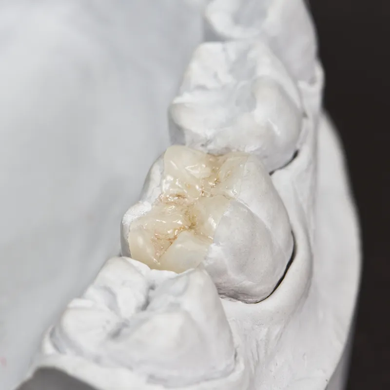 composite resin