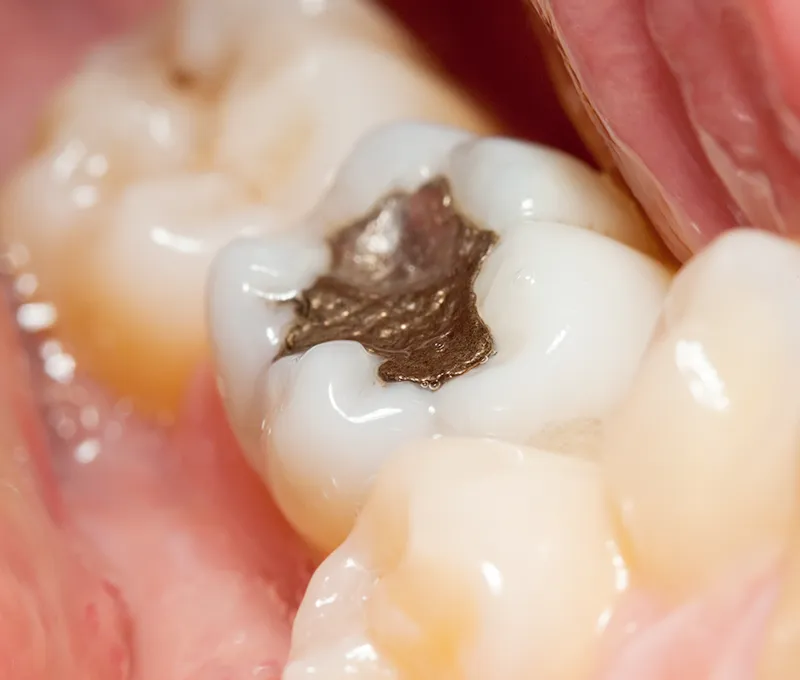 Dental fillings