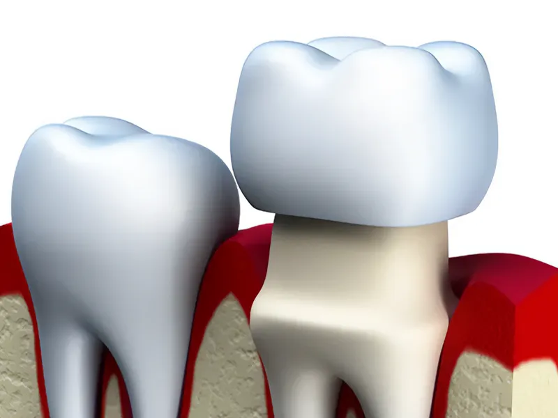 Dental crown