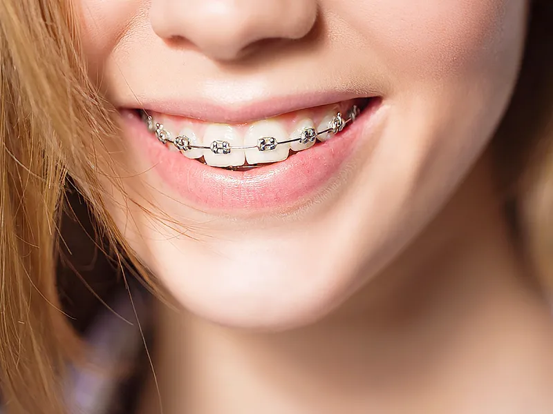 orthodontic treatment orthodontic treatment