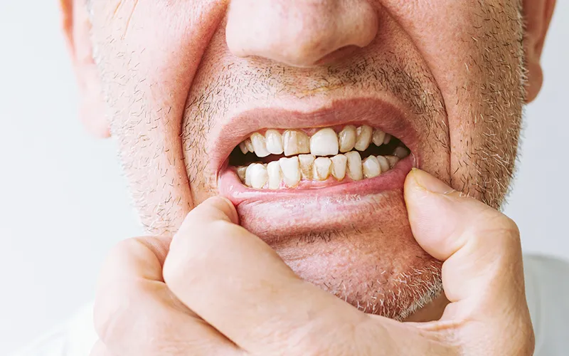 Malocclusion issues Malocclusion issues