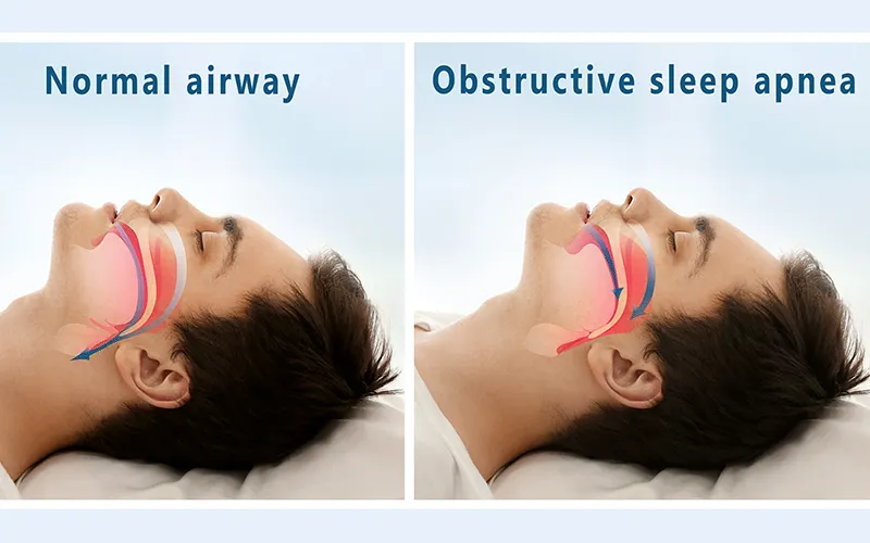 Obstructive Sleep Apnea Obstructive Sleep Apnea