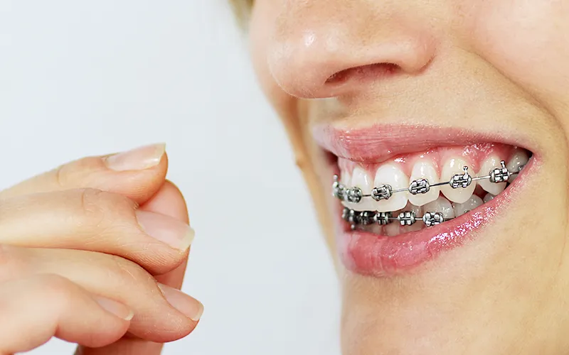 Braces for adults Braces for adults
