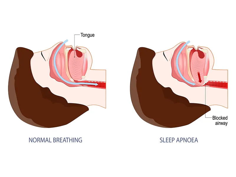 sleep apnoea
