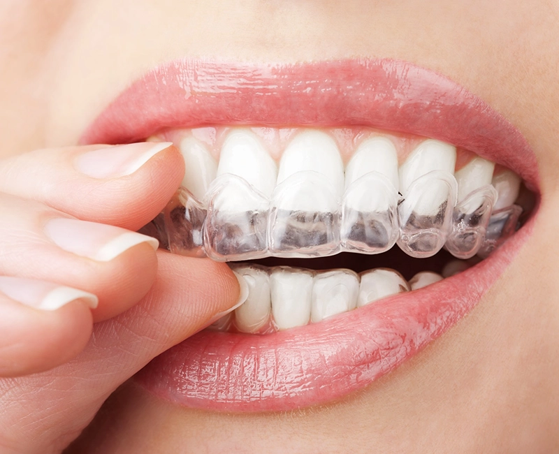 Clear Aligners