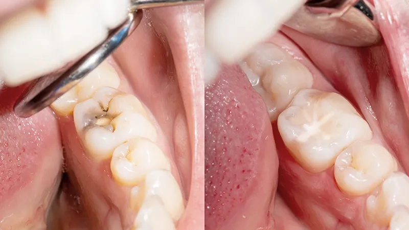 Dental fillings