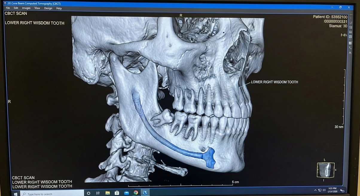 Why wisdom teeth removal is better done sooner than later