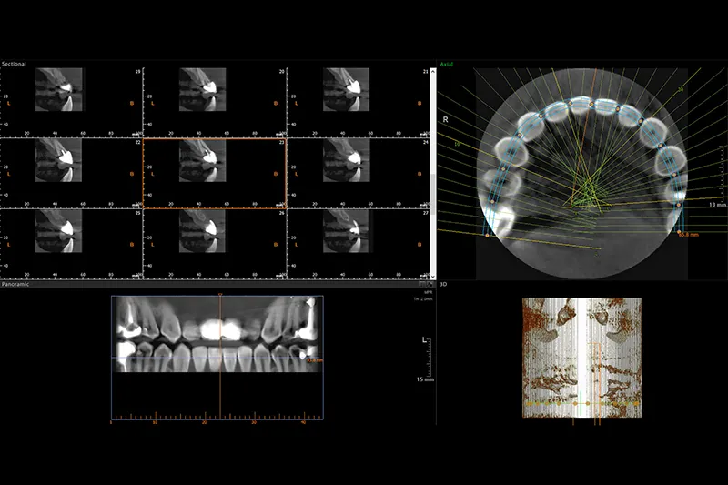 CBCT 3D scann