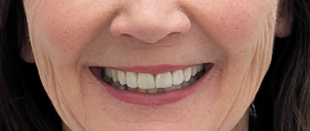 Case Study - Replacing Compromise Porcelain Veneers