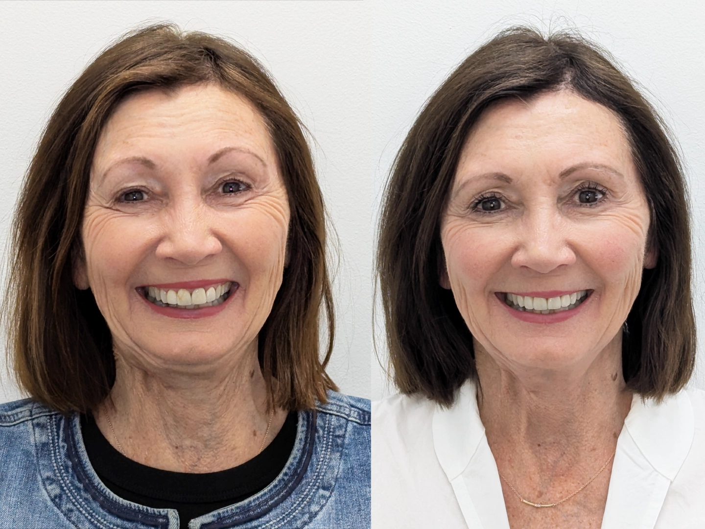 Case Study: Replacing Compromise Porcelain Veneers