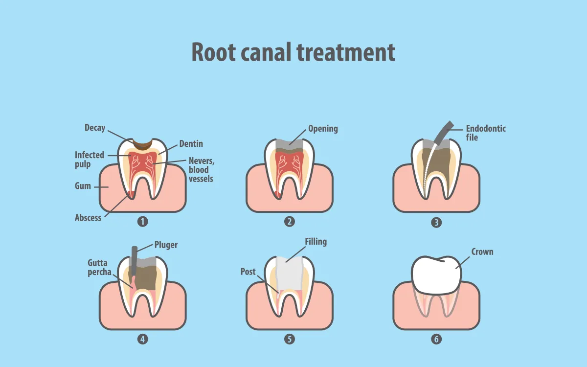  root canal therapy