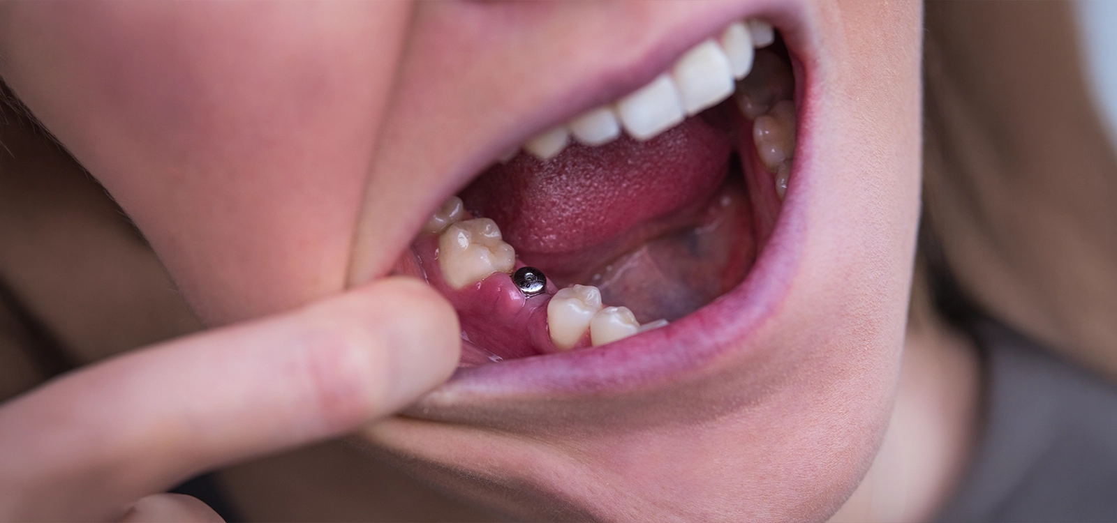 When tooth removal is the best call