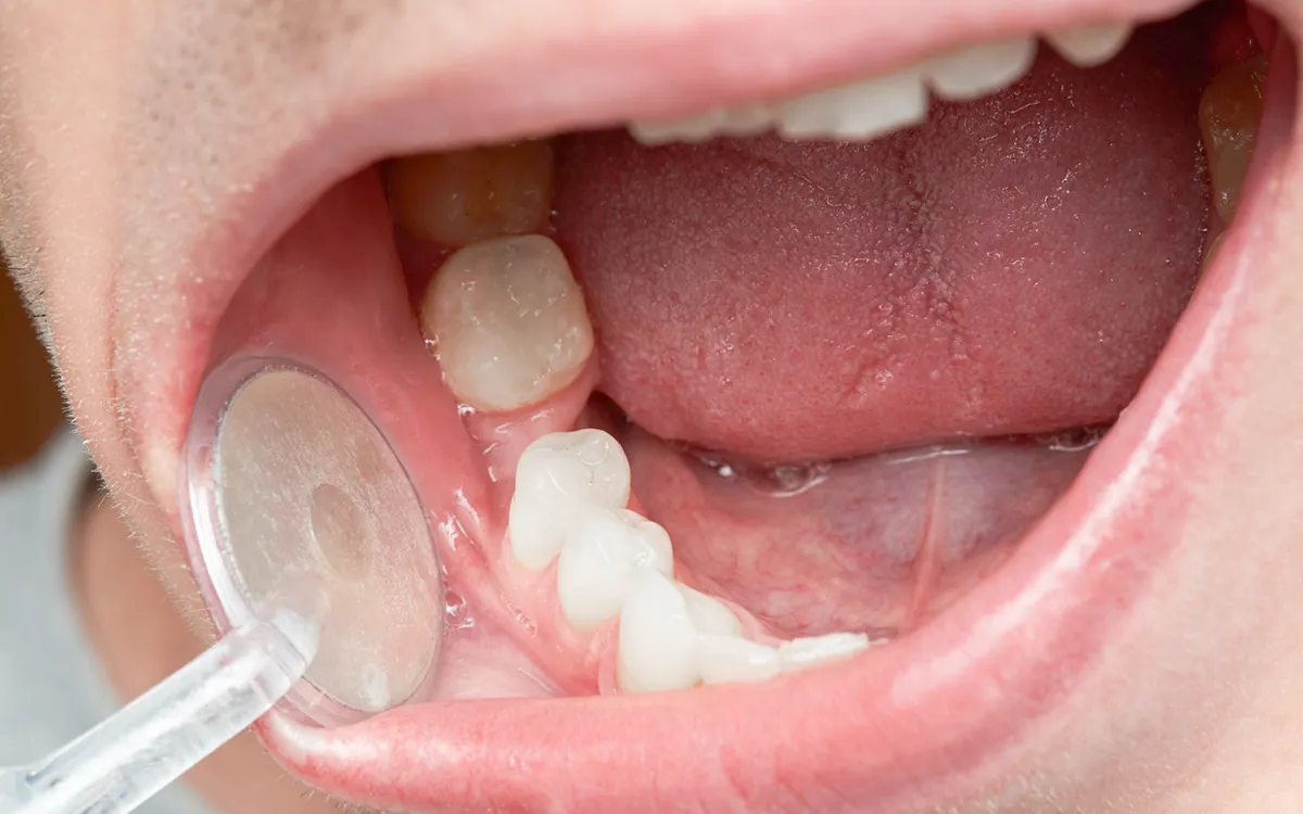 When tooth removal is the best call