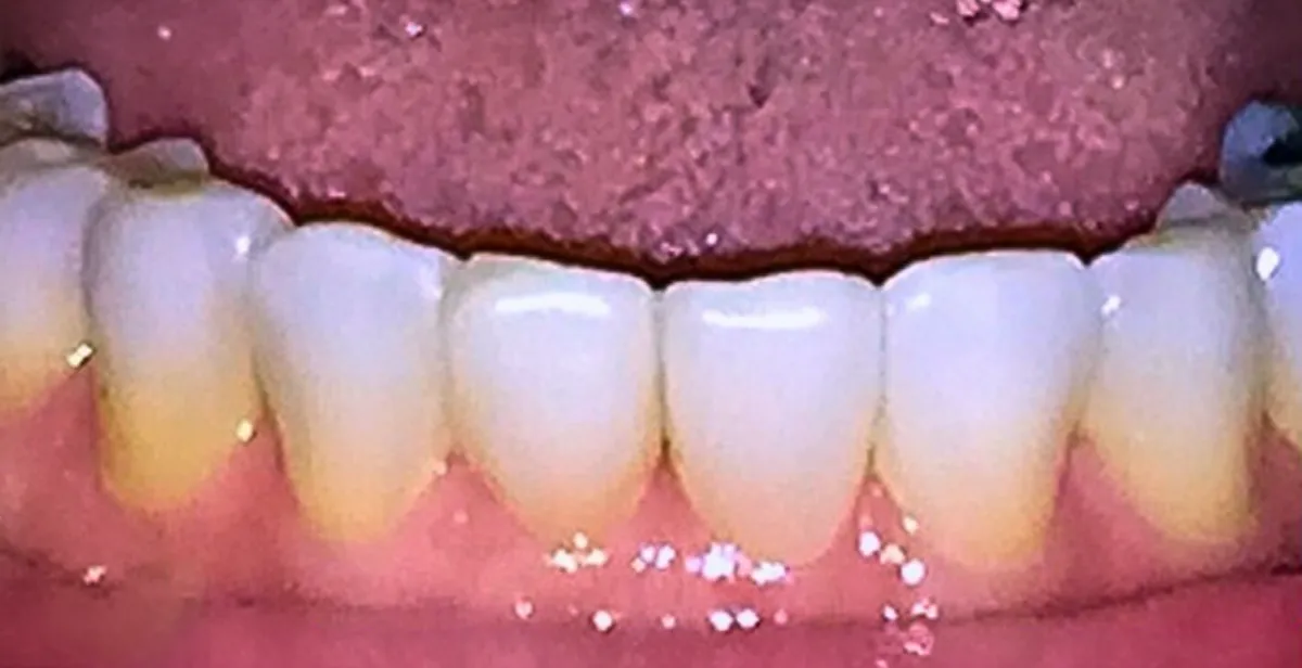 After dental treatment