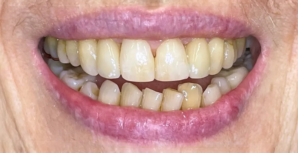 Starting braces at 79 years of age
