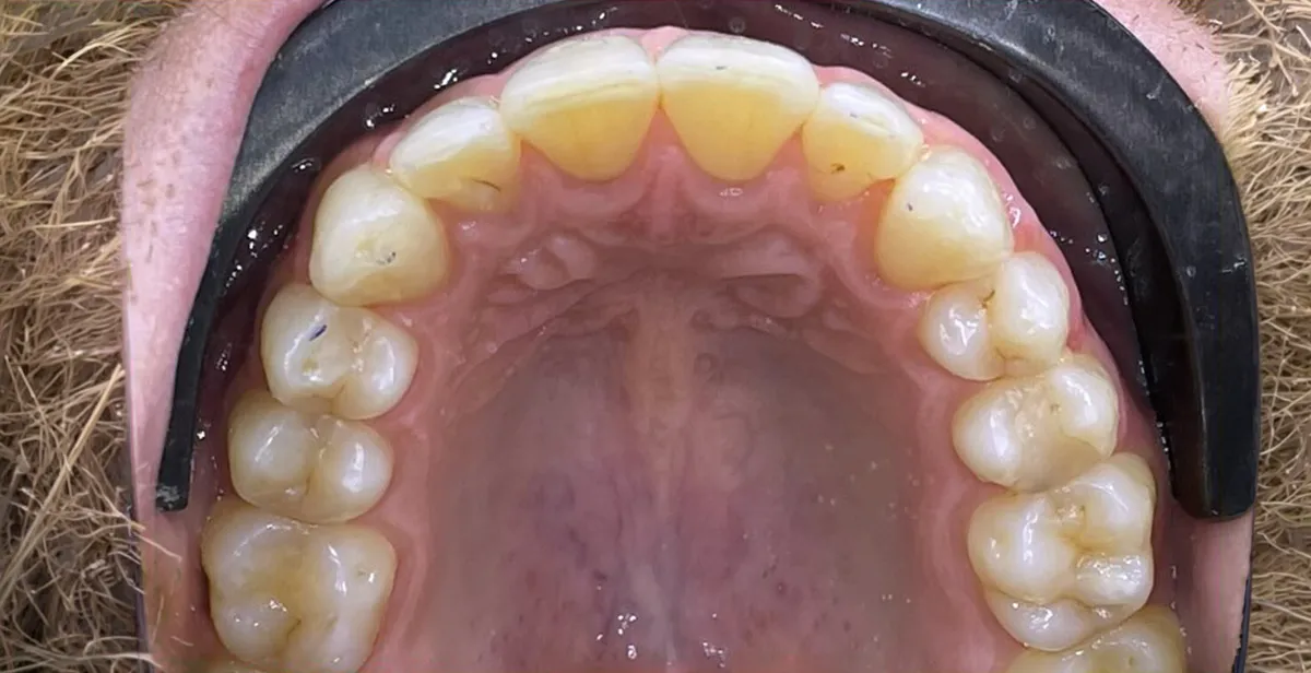 After dental treatment