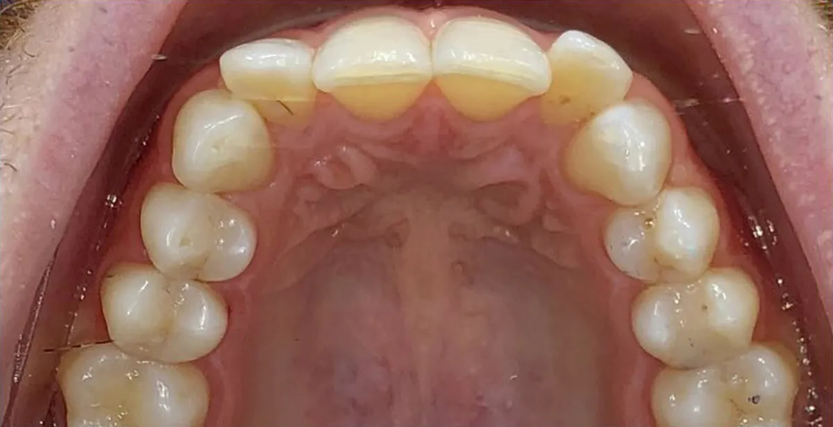 Before dental treatment
