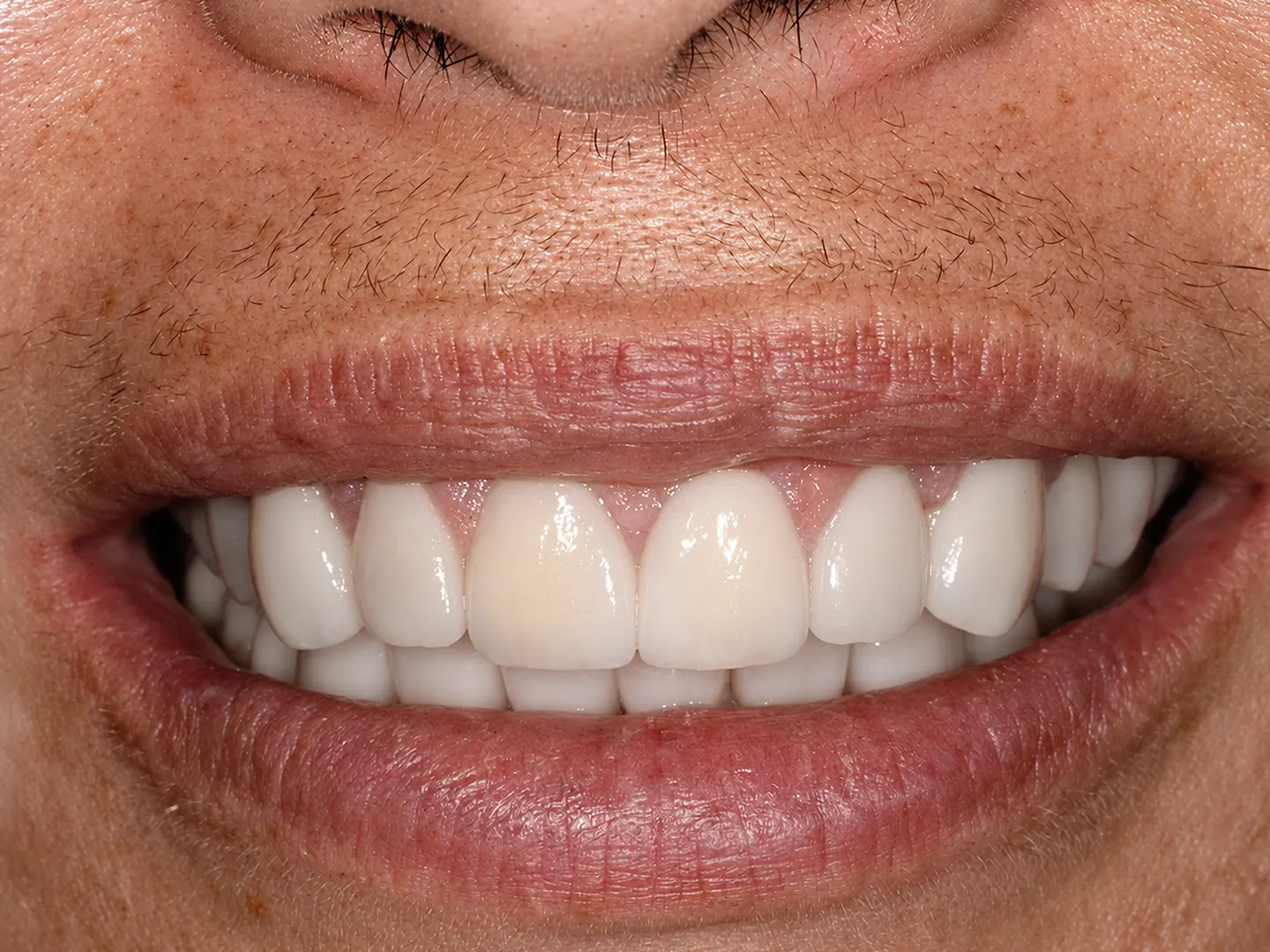 Starting braces at 79 years of age