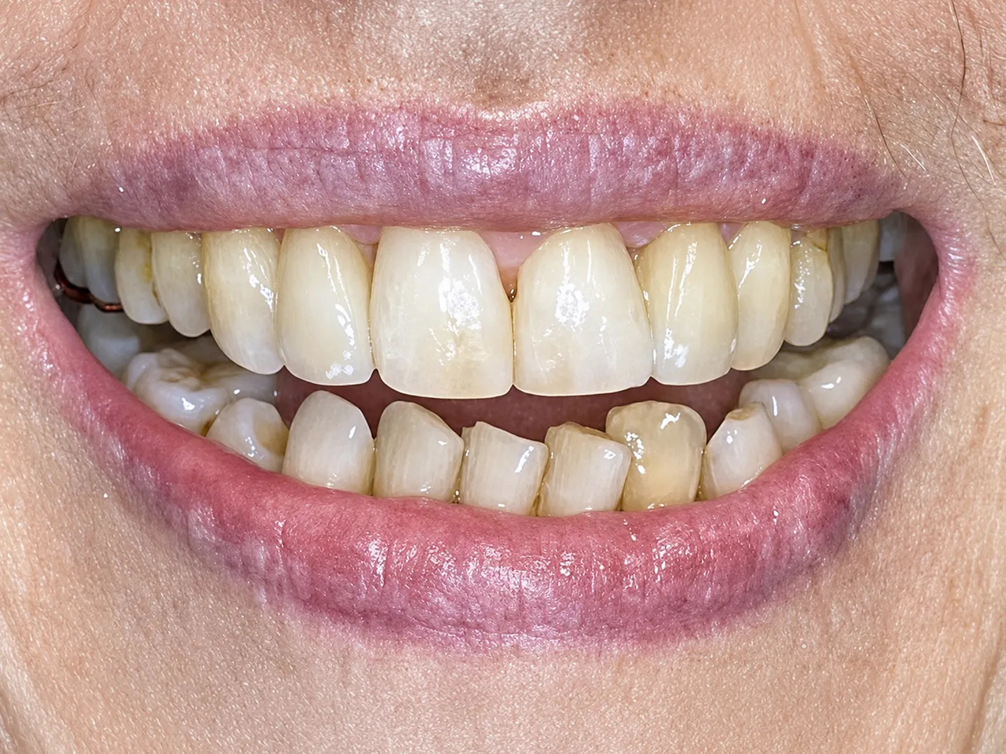 Starting braces at 79 years of age