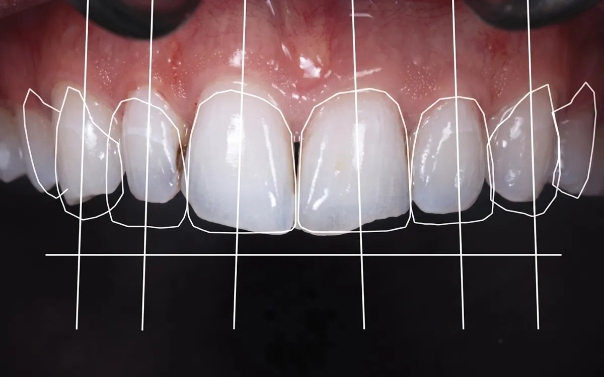 digital smile design