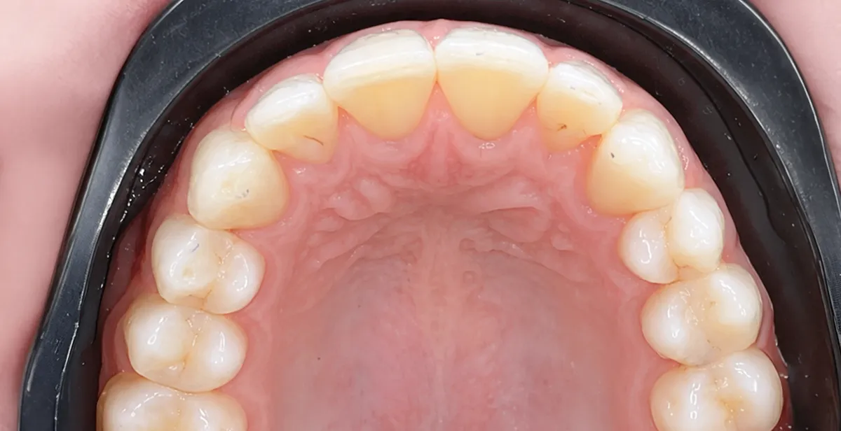 After dental treatment