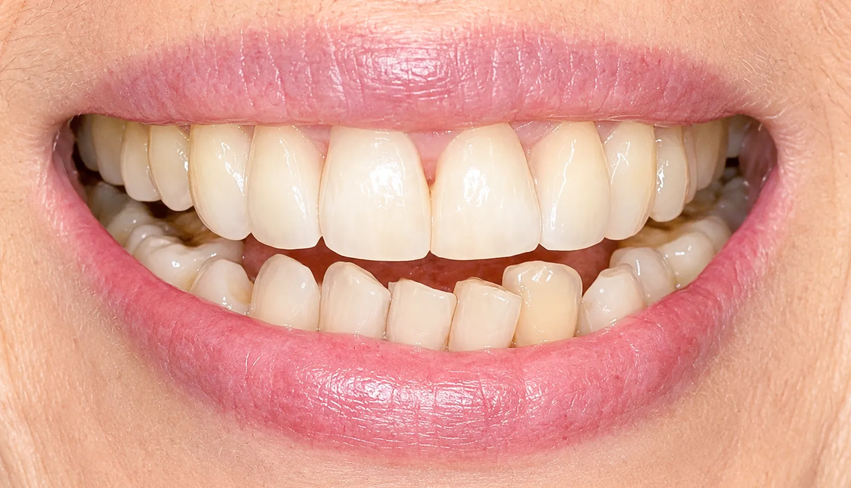 After dental treatment
