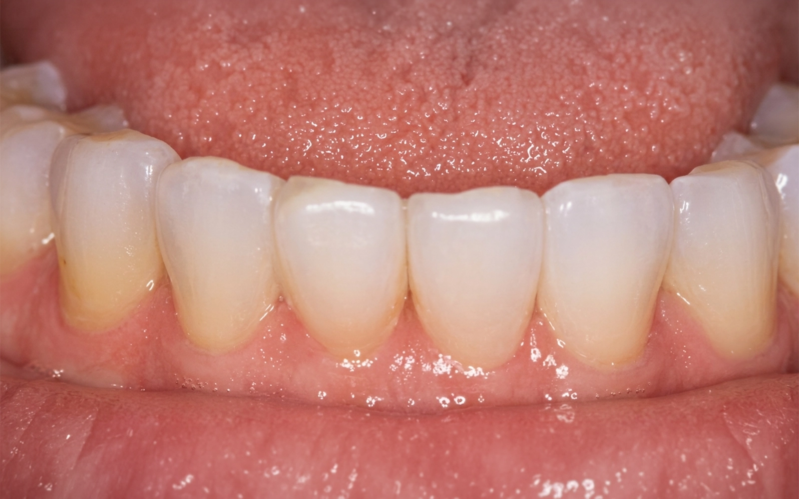 After dental treatment
