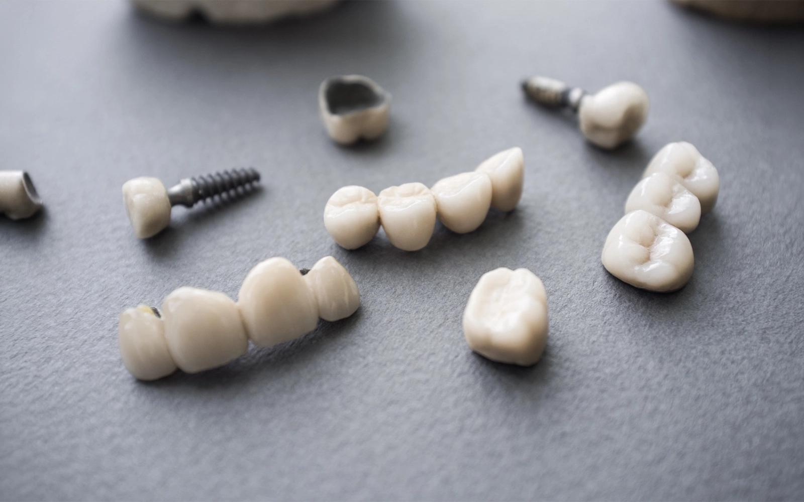 no-prep veneers