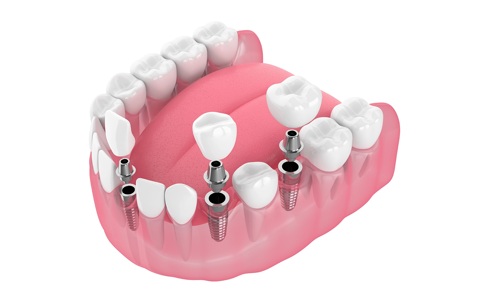 no-prep veneers