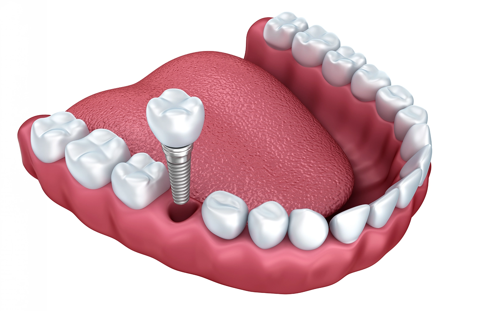 enamel preservation matters