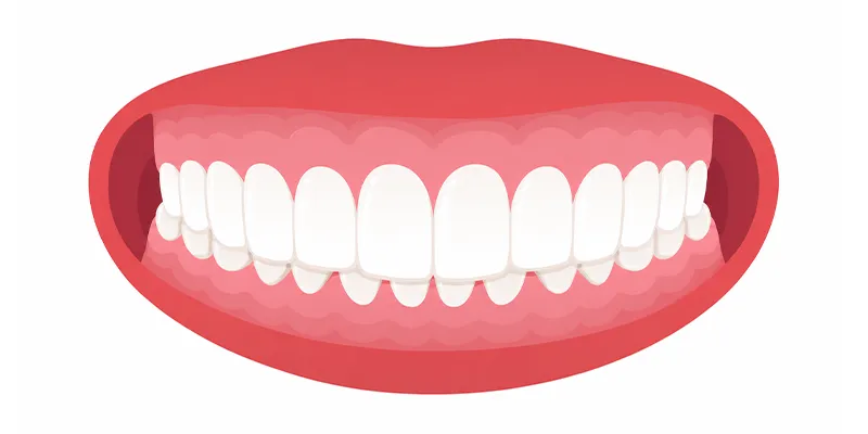 Overbite
