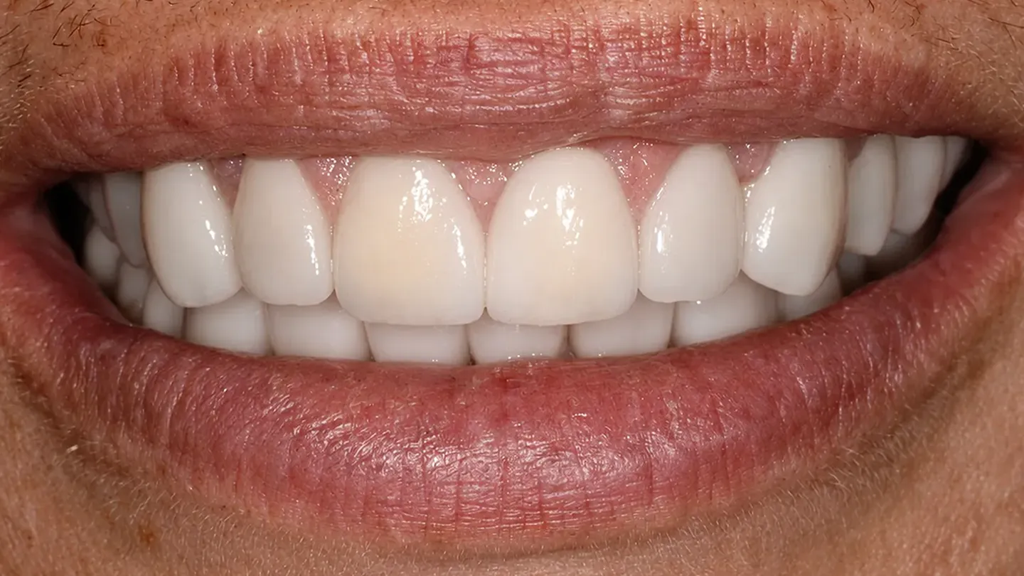 Starting braces at 79 years of age