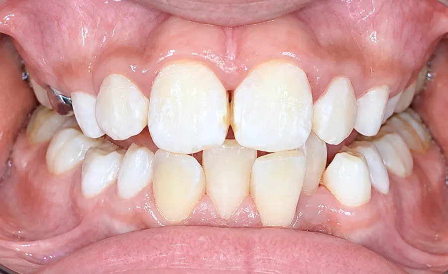 bite changed over time